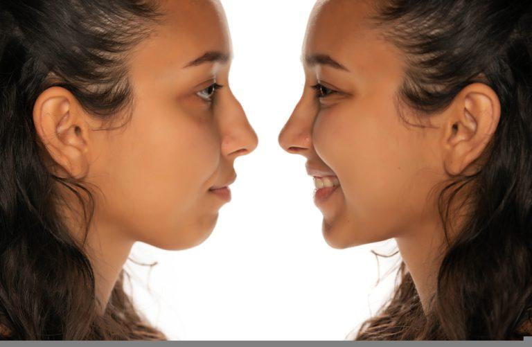 comparison,portrait,of,young,latin,woman,before,and,after,nose