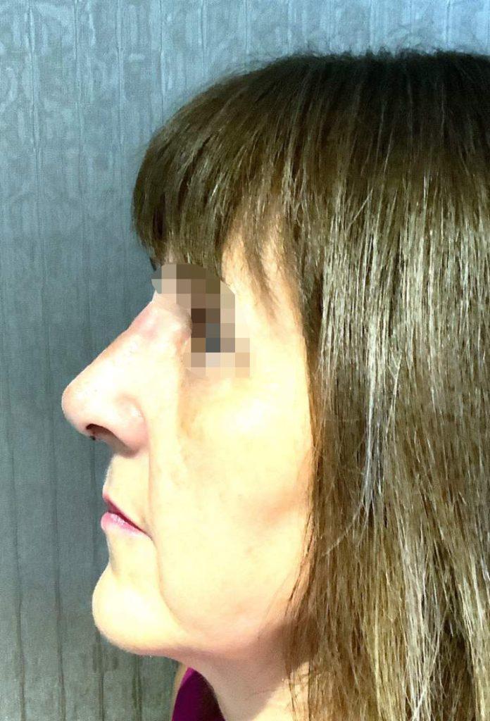 rhinoplasty case 9 postop 2 weeks