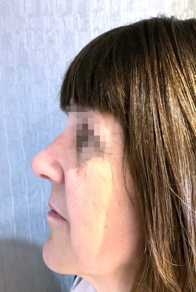 rhinoplasty case 9 postop 3 months