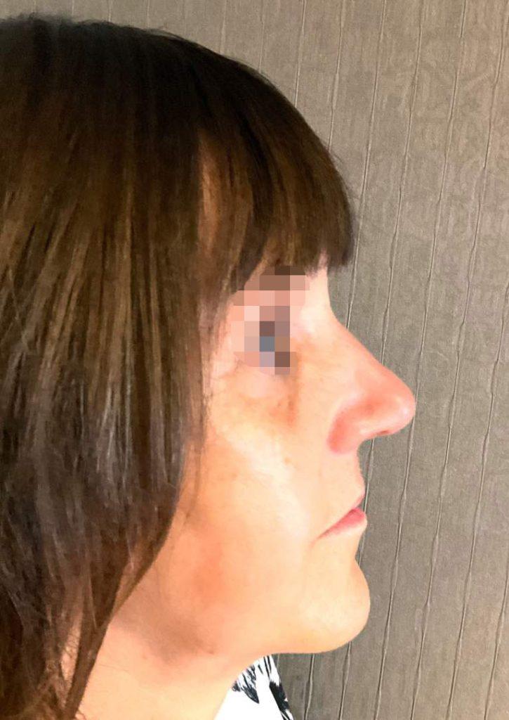 rhinoplasty case 9 postop 3 months