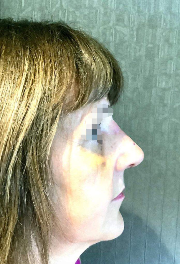 rhinoplasty case 9 postop 2 weeks
