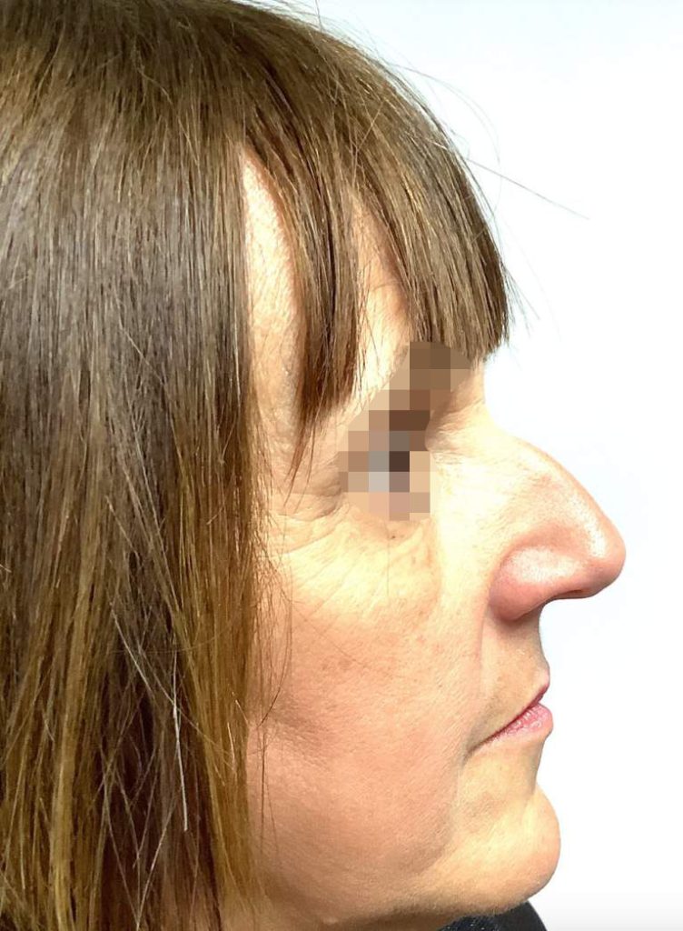 rhinoplasty case 9 preop