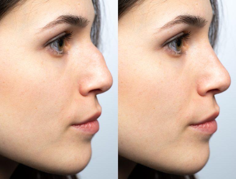 closeup,of,a,young,woman's,nose,before,and,after,nasal